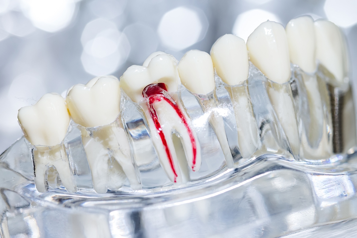 Root Canal In Orlando
