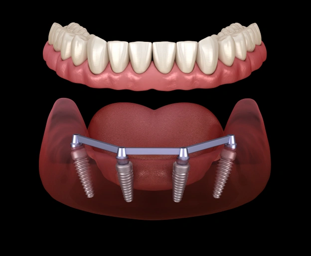 All-On-4 Implants in Orlando, FL