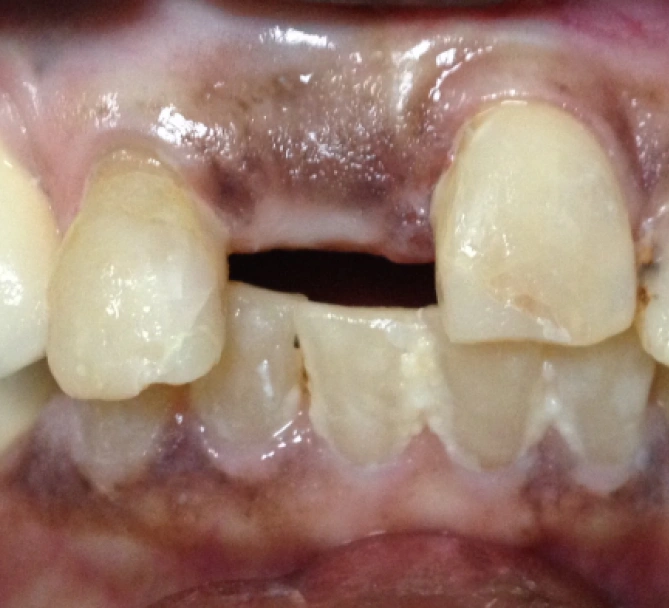 Before