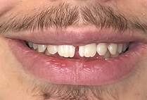 Before
