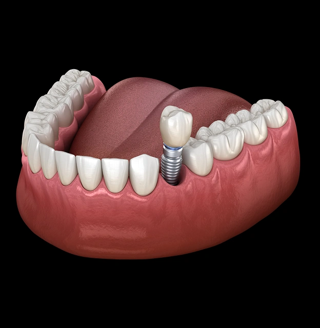 Dental Implants in Orlando, FL