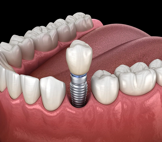 Dental-Implant